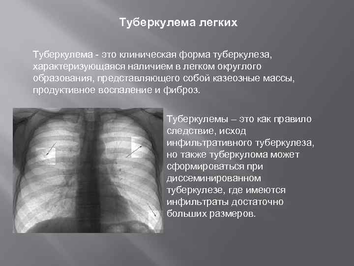 Туберкулема легких Туберкулема - это клиническая форма туберкулеза, характеризующаяся наличием в легком округлого образования,