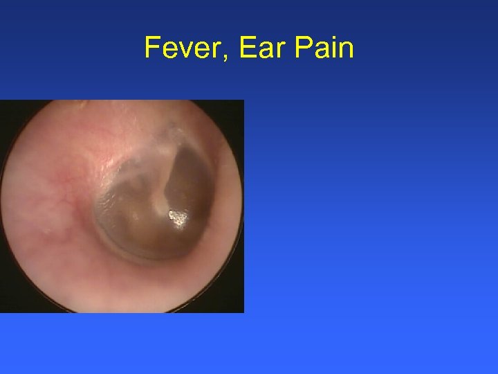 Fever, Ear Pain 