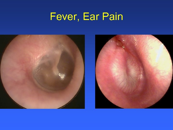 Fever, Ear Pain 