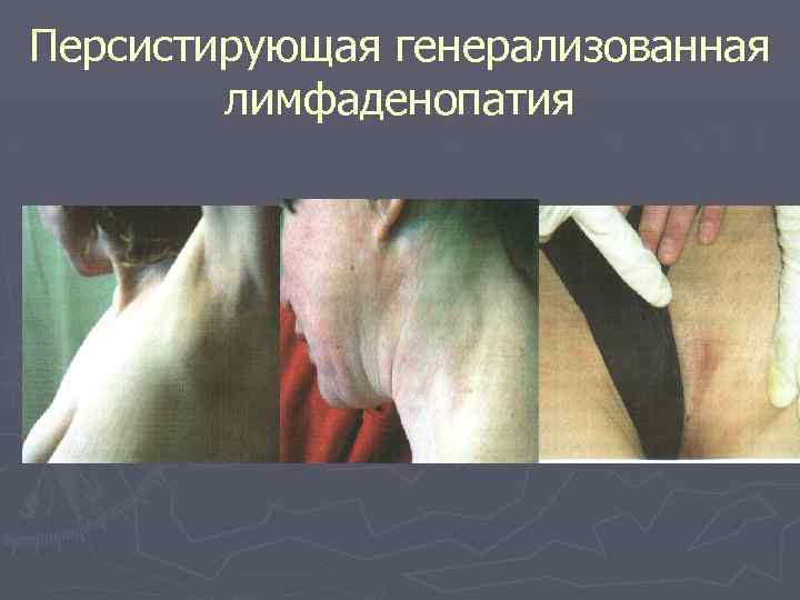 Персистирующая генерализованная лимфаденопатия 
