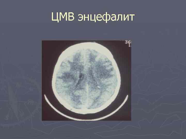 ЦМВ энцефалит 