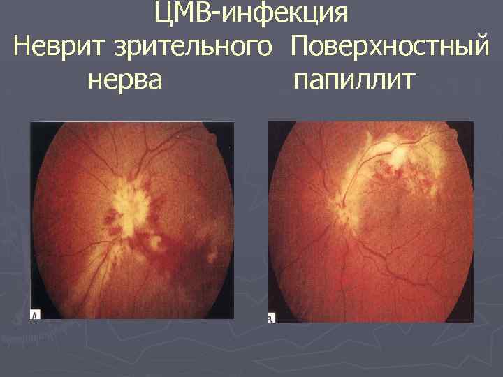 ЦМВ инфекция Неврит зрительного Поверхностный нерва папиллит 