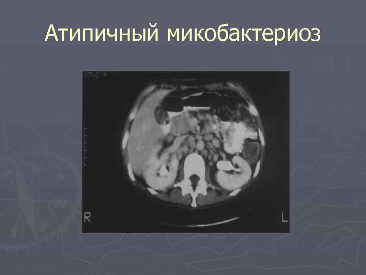 Атипичный микобактериоз 