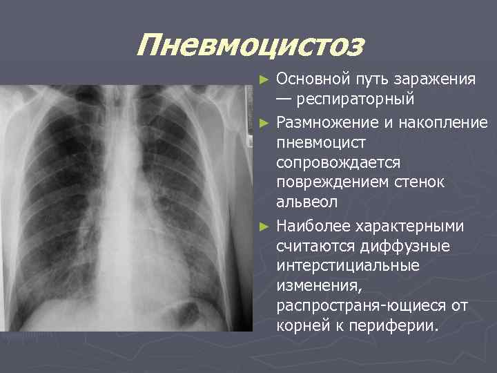 Пневмоцистоз Основной путь заражения — респираторный ► Размножение и накопление пневмоцист сопровождается повреждением стенок