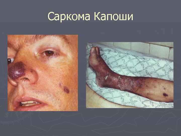 Саркома Капоши 