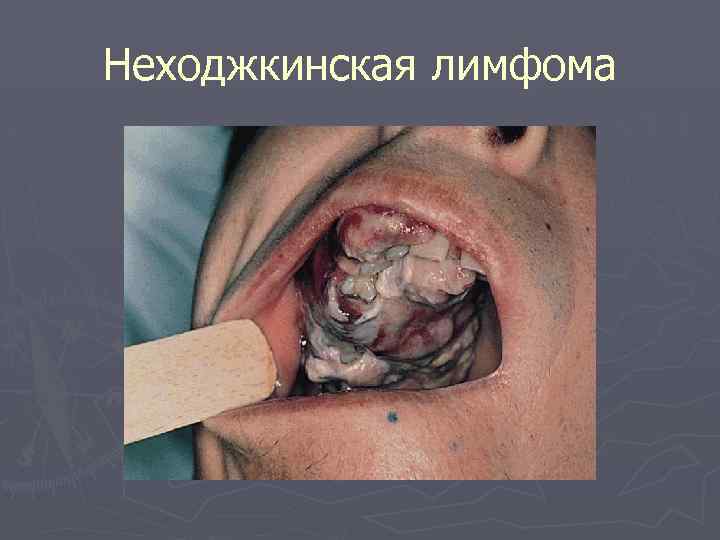 Неходжкинская лимфома 