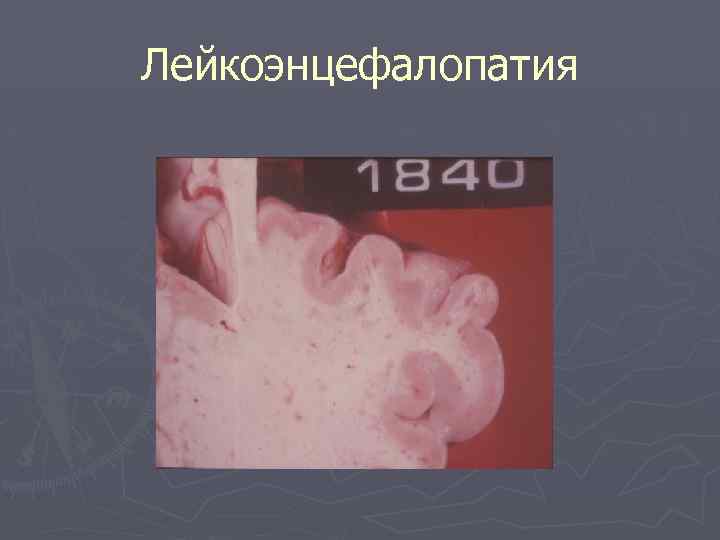 Лейкоэнцефалопатия 