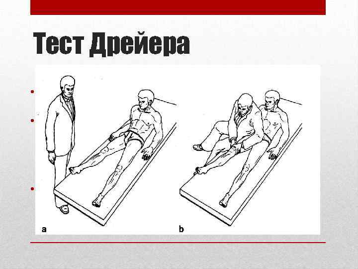 Тест Дрейера • Предназначен для диагностики отрыва сухожилия четырёхглавой мышцы от верхнего полюса надколенника