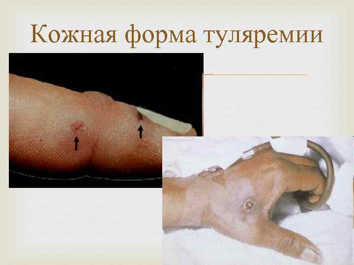 Кожная форма туляремии 