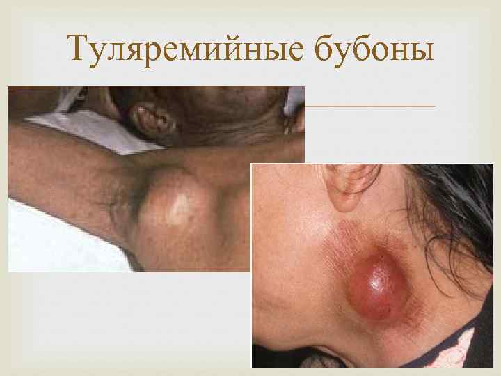 Туляремийные бубоны 