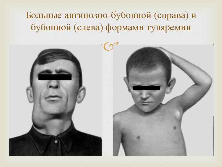 Больные ангинозно-бубонной (справа) и бубонной (слева) формами туляремии 