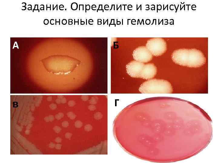 Задание. Определите и зарисуйте основные виды гемолиза А Б в Г 