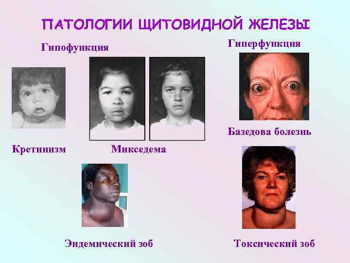 ПАТОЛОГИИ ЩИТОВИДНОЙ ЖЕЛЕЗЫ Гипофункция Гиперфункция Базедова болезнь Кретинизм Микседема Эндемический зоб Токсический зоб 