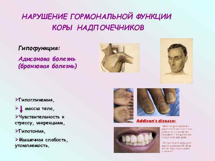 НАРУШЕНИЕ ГОРМОНАЛЬНОЙ ФУНКЦИИ КОРЫ НАДПОЧЕЧНИКОВ Гипофункция: Адисонова болезнь (бронзовая болезнь) ØГипогликемия, Ø массы тела,