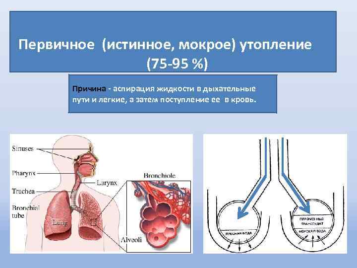 Первичное (истинное, мокрое) утопление (75 -95 %) Причина - аспирация жидкости в дыхательные пути