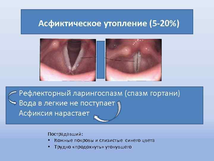 Асфиктическое утопление (5 -20%) Рефлекторный ларингоспазм (спазм гортани) Вода в легкие не поступает Асфиксия