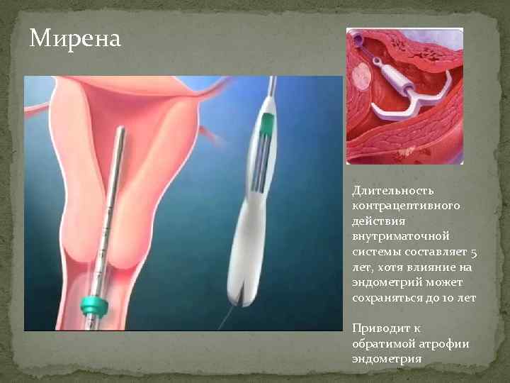 Мирена Длительность контрацептивного действия внутриматочной системы составляет 5 лет, хотя влияние на эндометрий может