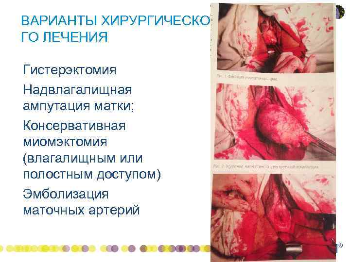ВАРИАНТЫ ХИРУРГИЧЕСКО ГО ЛЕЧЕНИЯ • • Гистерэктомия Надвлагалищная ампутация матки; Консервативная миомэктомия (влагалищным или