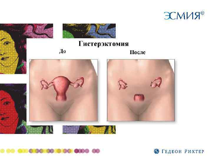 Mioma Matki Novosibirskij Gosudarstvennyj Medicinskij Universitet Kafedra Akusherstva