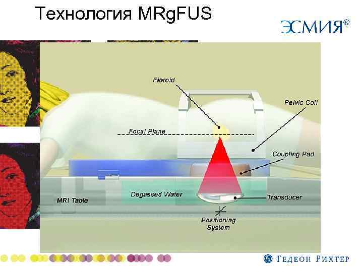 Технология MRg. FUS 