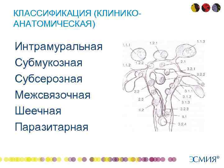 Интрамуральная лейомиома матки что это