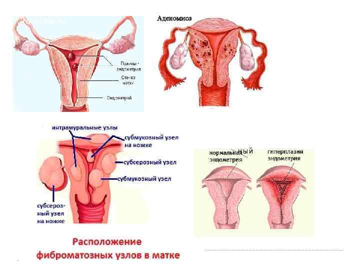 Маточное кровотечение картинки