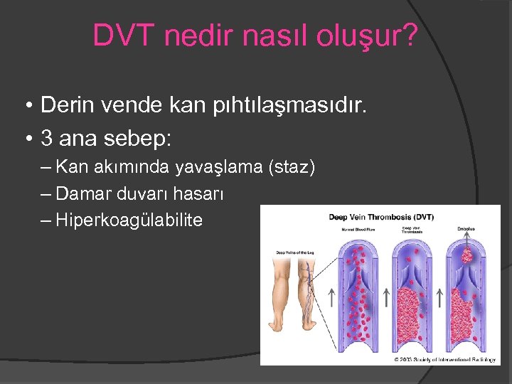 DVT nedir nasıl oluşur? • Derin vende kan pıhtılaşmasıdır. • 3 ana sebep: –