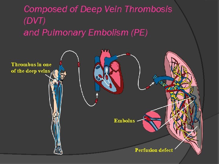 Composed of Deep Vein Thrombosis (DVT) and Pulmonary Embolism (PE) Thrombus in one of