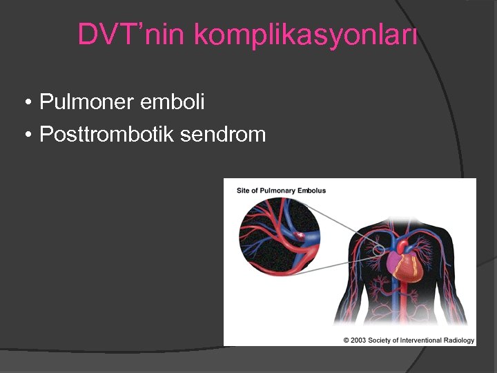 DVT’nin komplikasyonları • Pulmoner emboli • Posttrombotik sendrom 