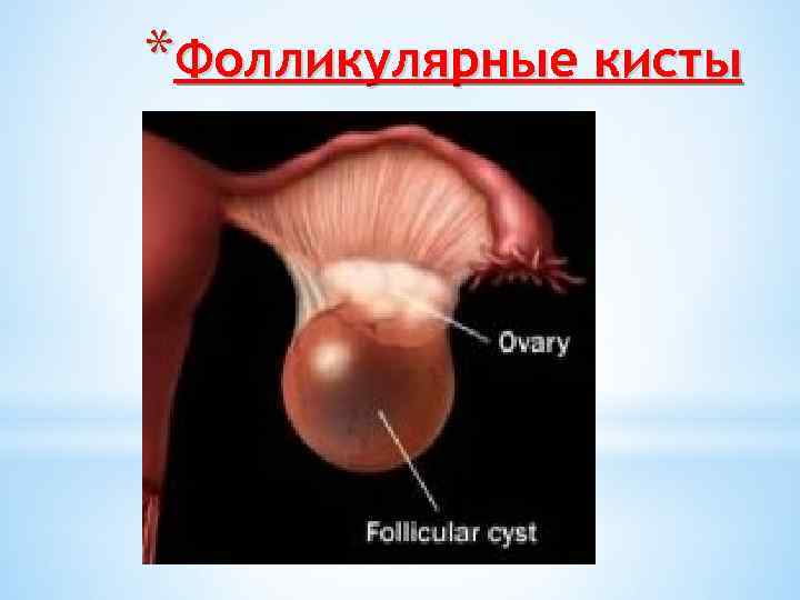 *Фолликулярные кисты 