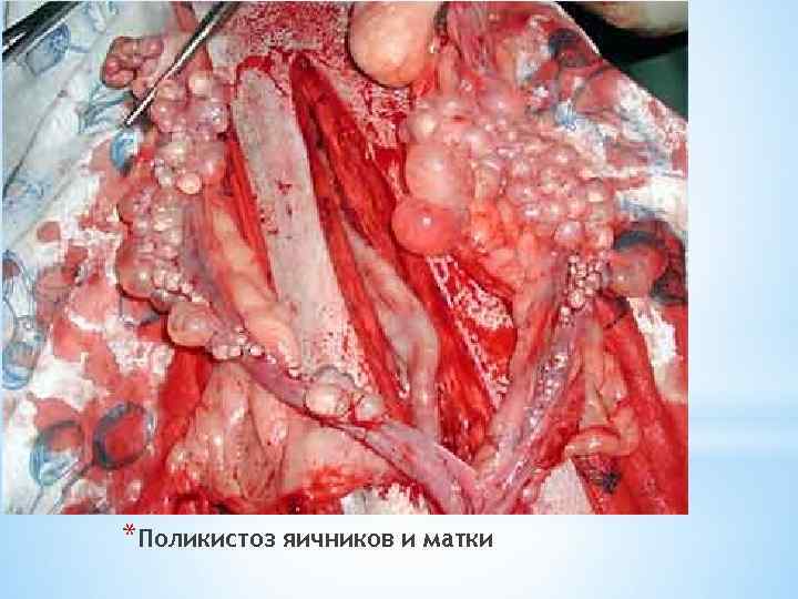 *Поликистоз яичников и матки 