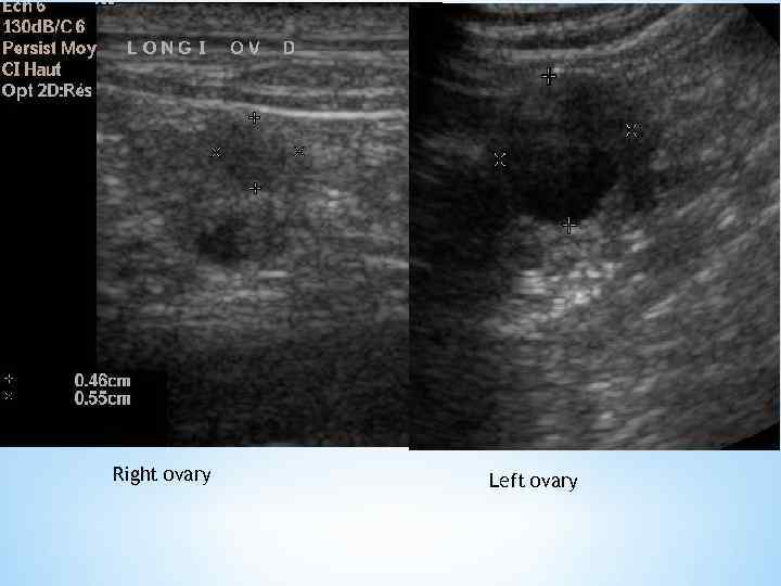 Right ovary Left ovary 