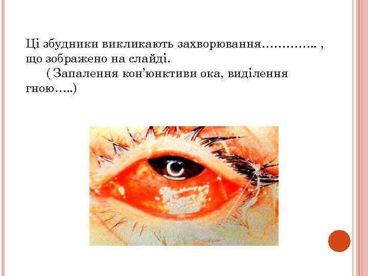 Ці збудники викликають захворювання…………. . , що зображено на слайді. ( Запалення кон’юнктиви ока,