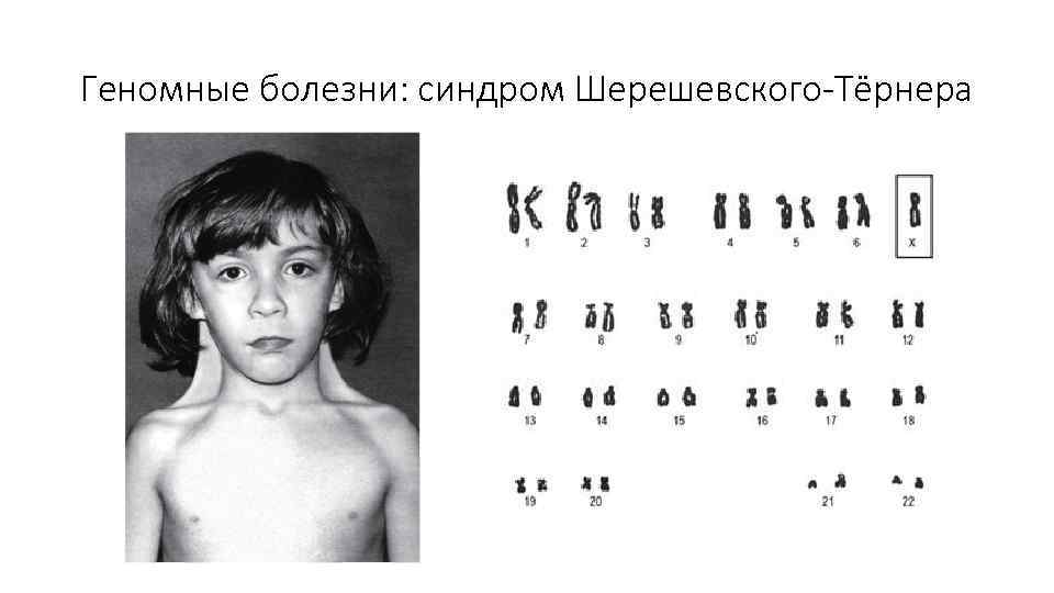 Геномные болезни: синдром Шерешевского-Тёрнера 