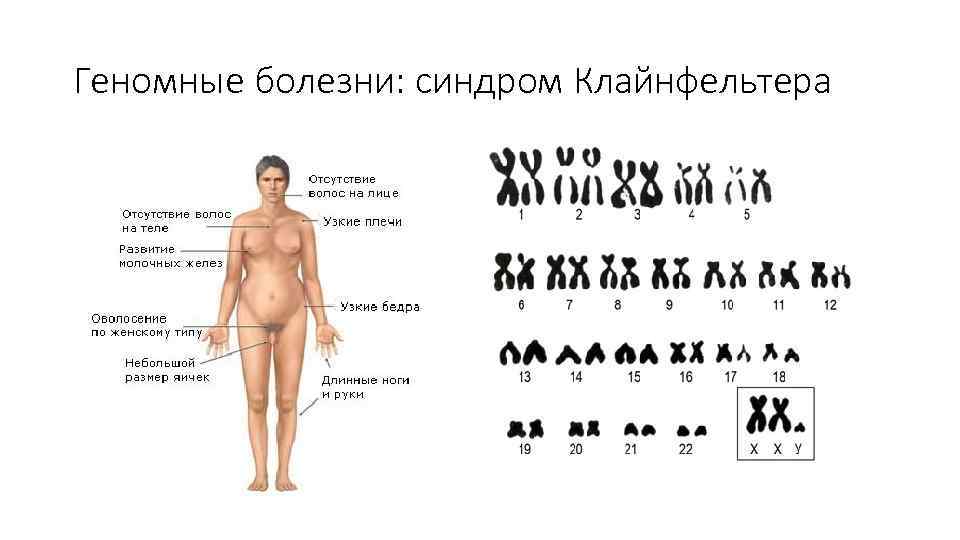 Геномные болезни: синдром Клайнфельтера 
