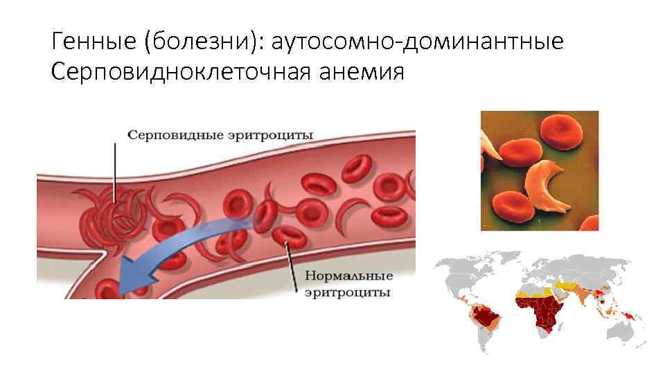 Кодоминантные заболевания серповидно-клеточная анемия. Серповидноклеточная анемия патофизиология. Серповидноклеточная анемия мутация. Аутосомно доминантные генные болезни.