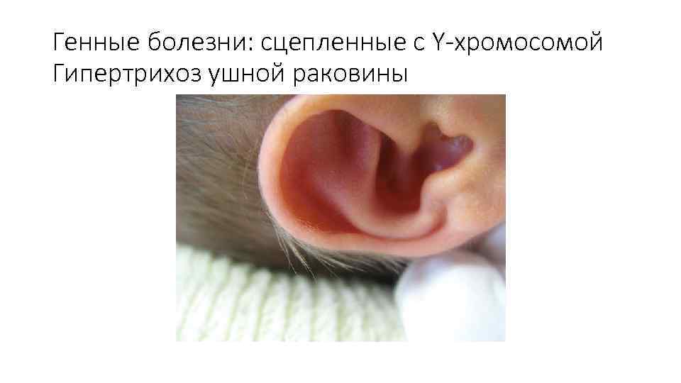 Генные болезни: сцепленные с Y-хромосомой Гипертрихоз ушной раковины 
