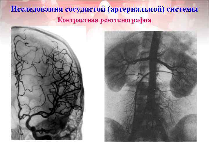 Исследования сосудистой (артериальной) системы Контрастная рентгенография 