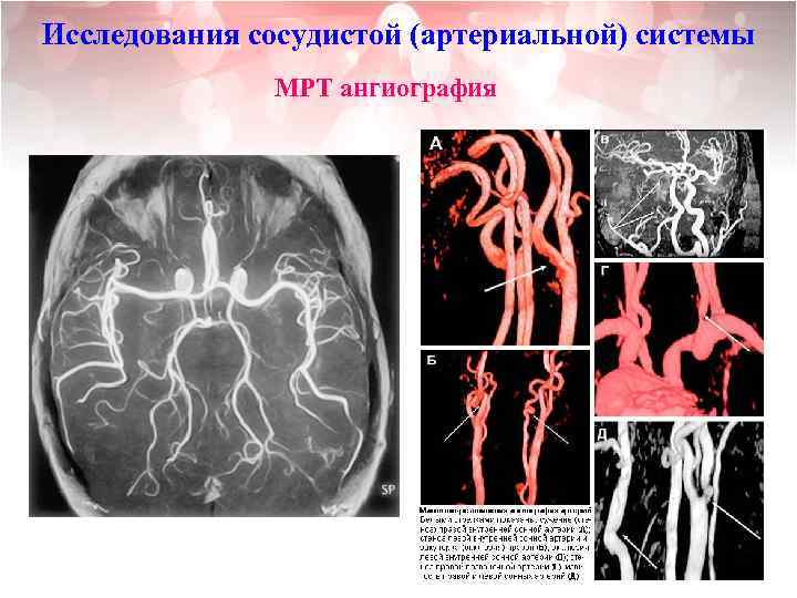 Исследования сосудистой (артериальной) системы МРТ ангиография 