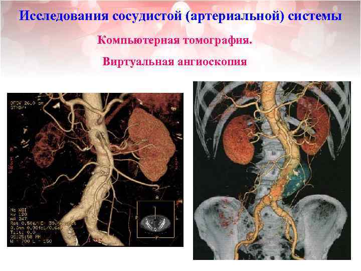 Исследования сосудистой (артериальной) системы Компьютерная томография. Виртуальная ангиоскопия 