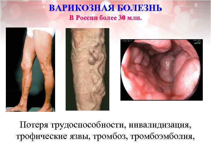 ВАРИКОЗНАЯ БОЛЕЗНЬ В России более 30 млн. Потеря трудоспособности, инвалидизация, трофические язвы, тромбоз, тромбоэмболия,
