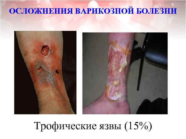 ОСЛОЖНЕНИЯ ВАРИКОЗНОЙ БОЛЕЗНИ Трофические язвы (15%) 