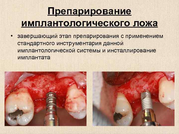 Препарирование имплантологического ложа • завершающий этап препарирования с применением стандартного инструментария данной имплантологической системы