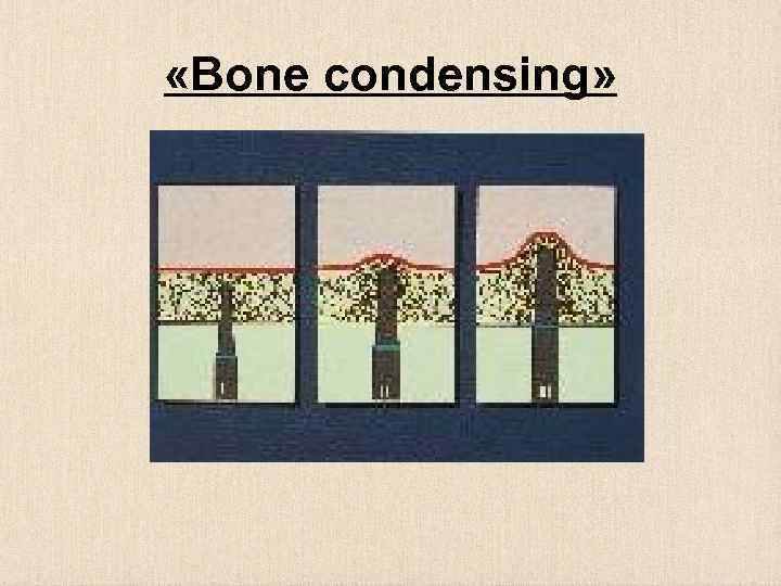  «Bone condensing» 