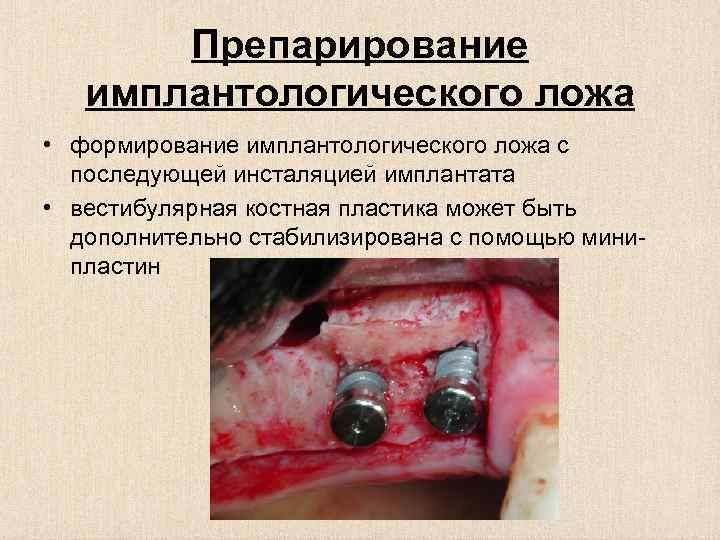 Препарирование имплантологического ложа • формирование имплантологического ложа с последующей инсталяцией имплантата • вестибулярная костная