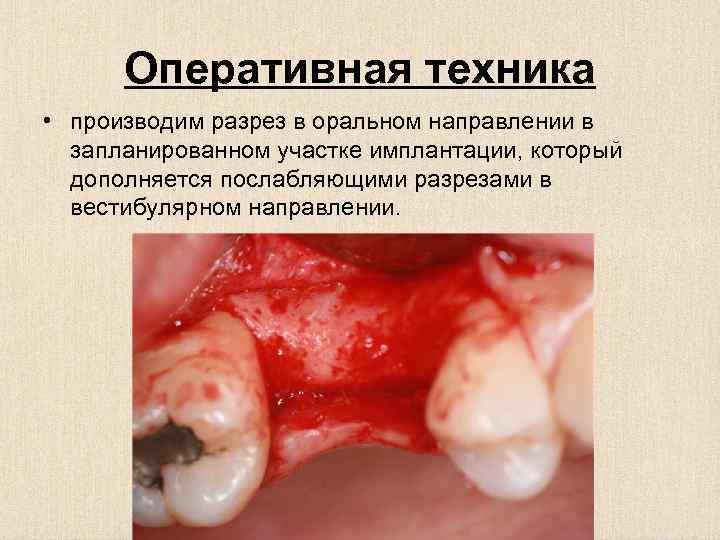 Оперативная техника • производим разрез в оральном направлении в запланированном участке имплантации, который дополняется