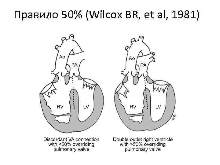 Правило 50% (Wilcox BR, et al, 1981) 