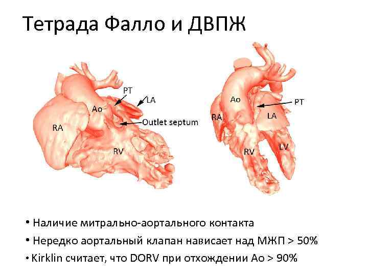Тетрада Фалло и ДВПЖ • Наличие митрально‐аортального контакта • Нередко аортальный клапан нависает над