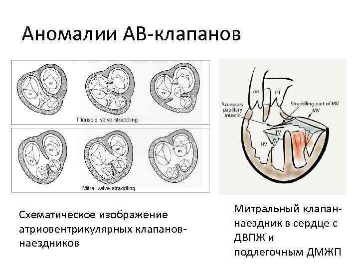 Где расположен митральный клапан