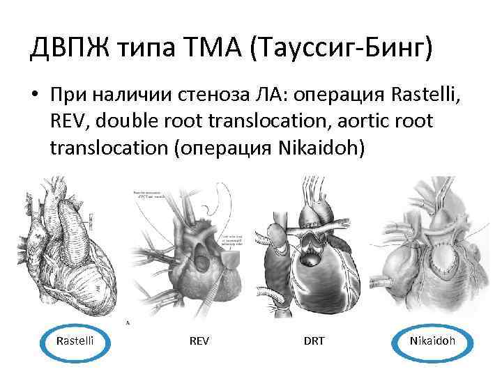 ДВПЖ типа ТМА (Тауссиг‐Бинг) • При наличии стеноза ЛА: операция Rastelli, REV, double root